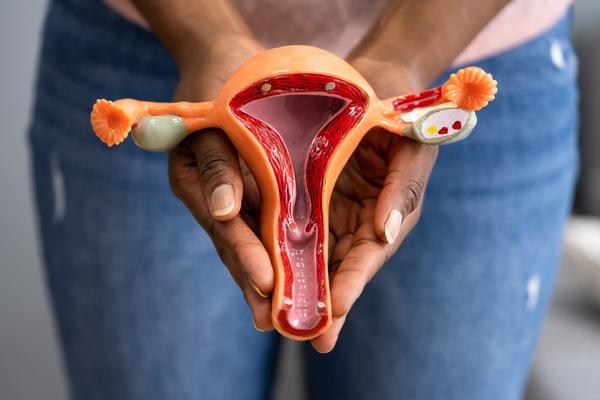 Diferenças raciais na associação de endometriose com risco de câncer de ovário