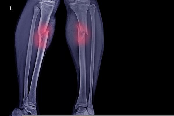 Vancomicina na ferida cirúrgica previne infecção nas fraturas do planalto tibial?