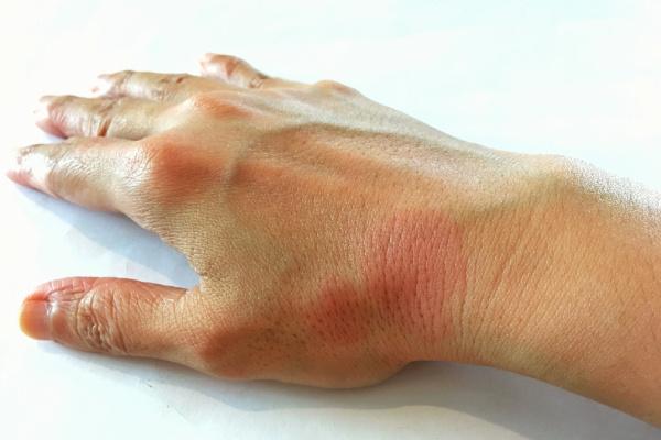 lúpus eritematoso sistêmico