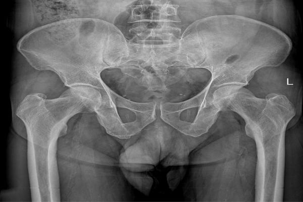 Quais são os fatores mais associados a pseudartrose de fraturas de fêmur distal?