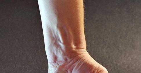 Qual é o melhor tratamento para lesão do ligamento lunopiramidal?