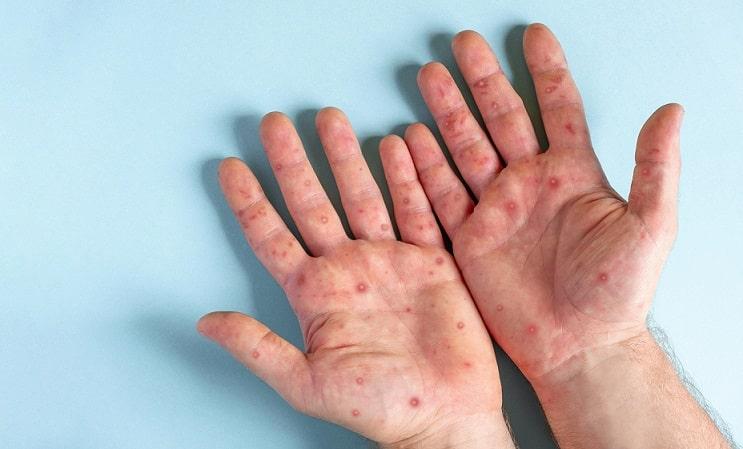 mãos com sinais de sífilis