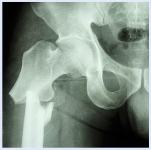 Características e risco para fraturas periprotéticas ao redor do quadril