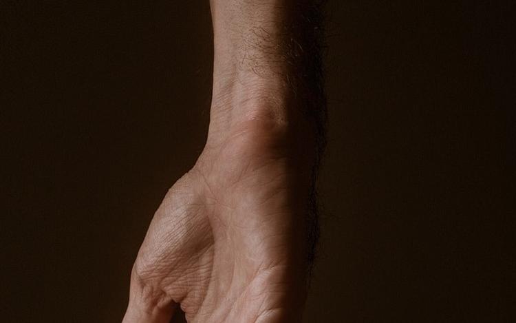 A anemia está associada a piores resultados em fraturas do rádio distal?