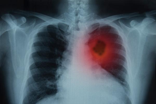 Aprovada a substância repotrectinib para tratamento de câncer de pulmão pela FDA