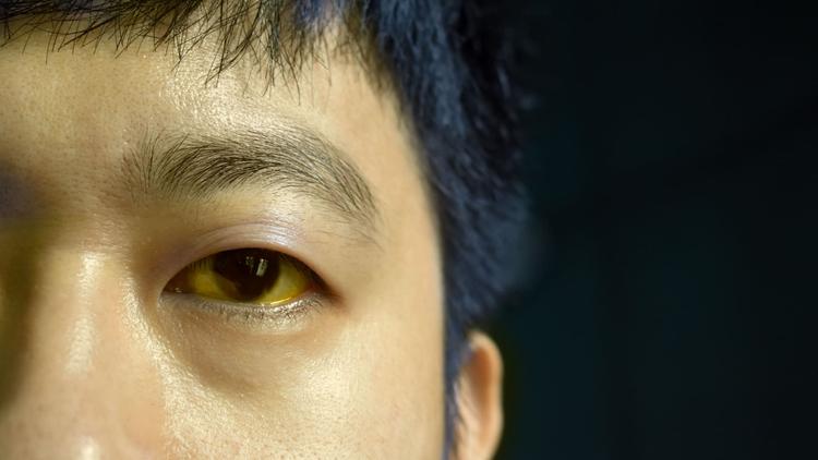 Close de homem oriental com olhos amarelados indicando insuficiência hepática aguda