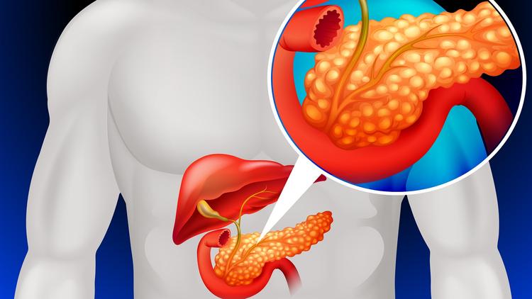 Um panorama atual sobre a pancreatite crônica