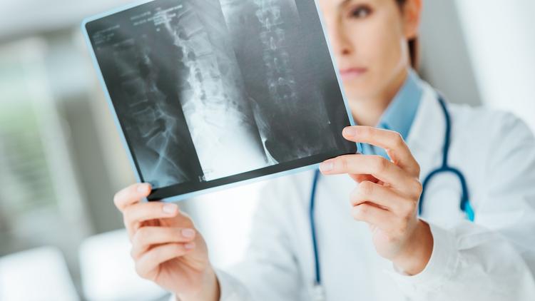 Tumores adrenais não funcionais relacionados ao aumento na incidência de fraturas?