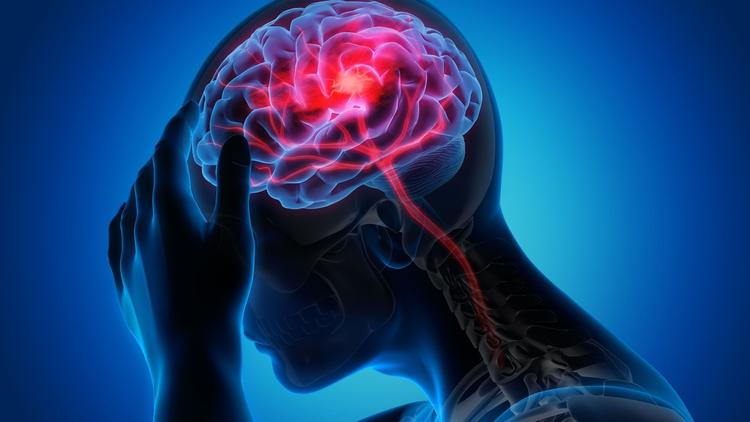 Estudo relaciona enxaqueca crônica a enfraquecimento da musculatura do pescoço