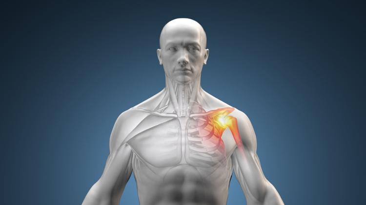 Ilustração da Síndrome de Parsonage Turner