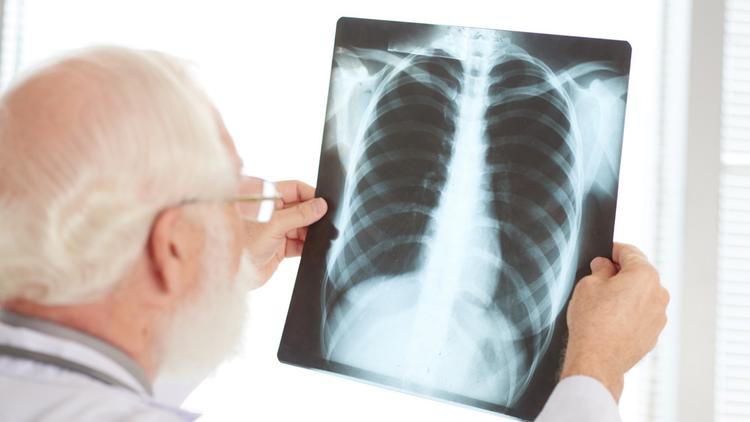 Estudo sugere que origem geográfica pode afetar risco de infecção por tuberculose