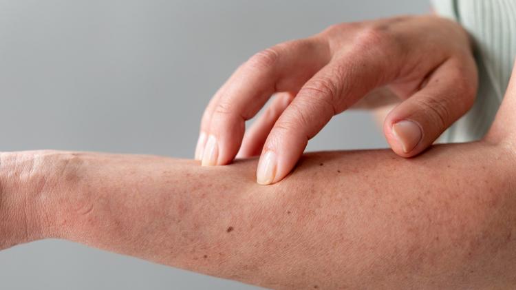 Urticária Uma revisão prática