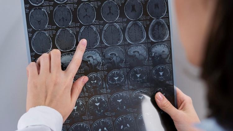 Trombose de seio cavernoso: como reconhecer e proceder