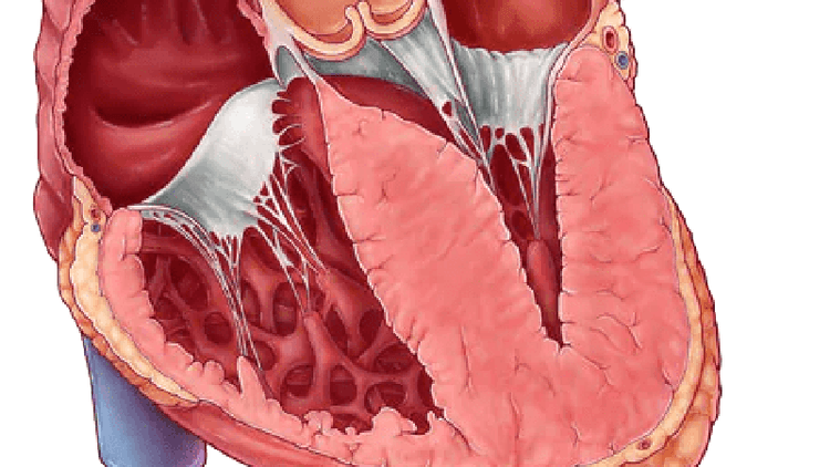Qualquer Hipertrofia de VE é Diagnóstica de Cardiomiopatia Hipertrófica?
