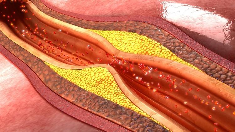 Inibidores de PCSK9 reduzem placa?