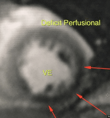 Ressonância cardíaca na investigação de doença coronariana estável?