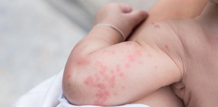 Dermatite atópica acomete sempre as dobras?