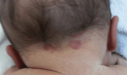 Diferenciando Mancha Salmão e Hemangioma: Compreendendo as Lesões Cutâneas em Recém-Nascidos