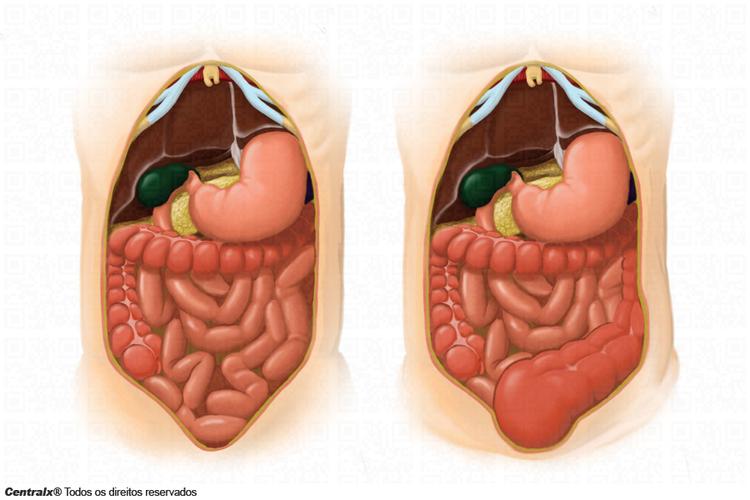 Uma revisão sobre o megacólon congênito
