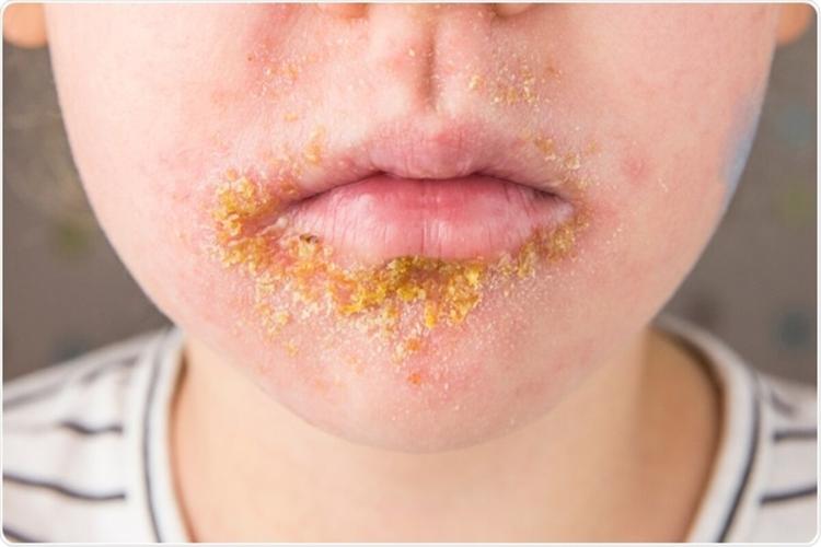O que é impetigo?