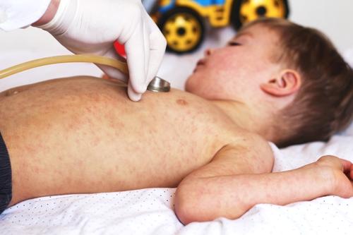 Como diagnosticar a Síndrome Inflamatória Multissistêmica Pediátrica Associada à Covid-19?