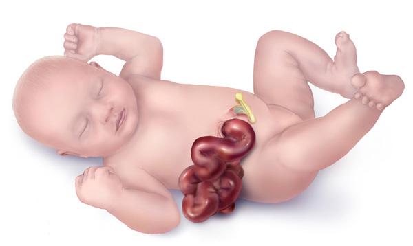 Fatos importantes sobre a gastrosquise: