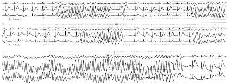 Já ouviu falar do desfibrilador que se pode vestir? Serve de algo?