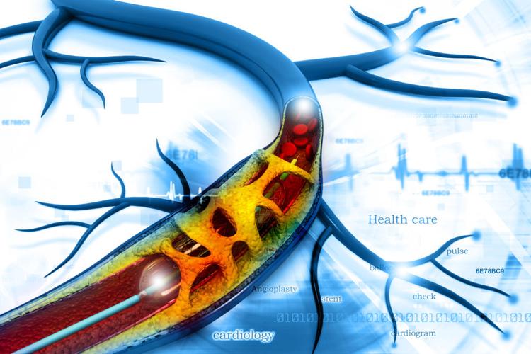 Videoaula gratuita: como melhorar o tratamento clínico após angioplastia coronariana?