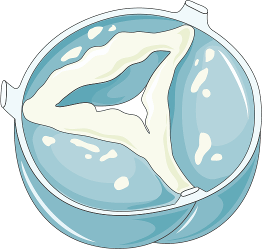 Estenose Aortica Bivalvar