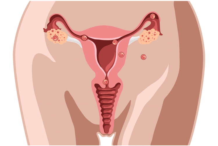 Tratamento de gestação ectópica