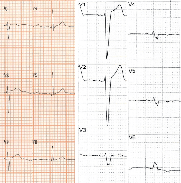 Curso básico de eletrocardiograma – parte 10 – Complexo QRS