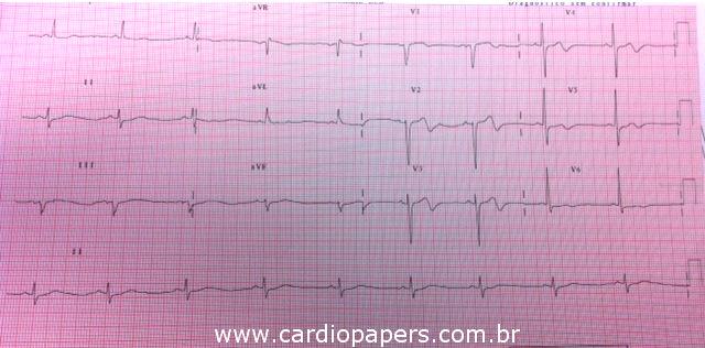 ECG: Por Que Temer o Plus / Minus Anterior?