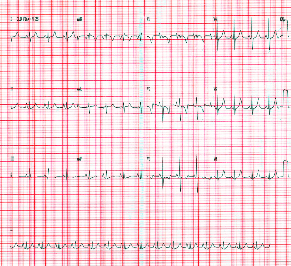 Curso básico de eletrocardiograma – parte 08 – Sobrecargas atrias