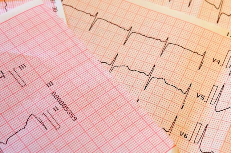 Quais os critérios de Sokolow para diagnóstico de sobrecarga de ventrículo esquerdo?