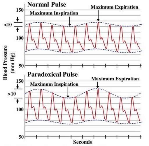 Como avaliar o Pulso paradoxal?