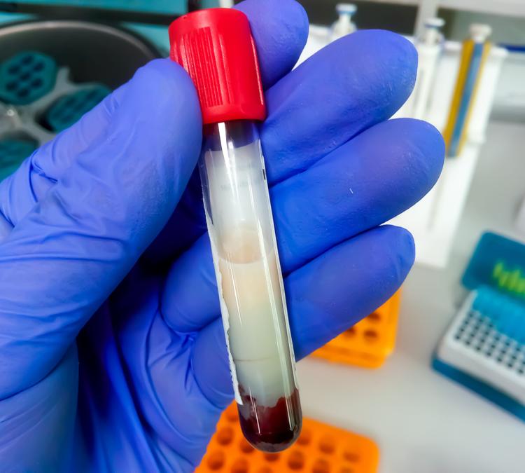 Olezarsen: novo tratamento para a quilomicronemia familiar