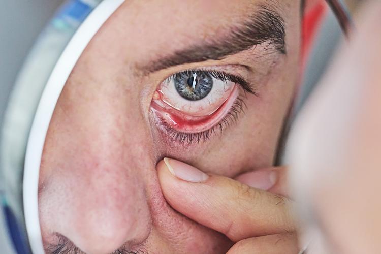 Teprotumumabe e Doença Ocular Tireoidiana: o que devemos saber?