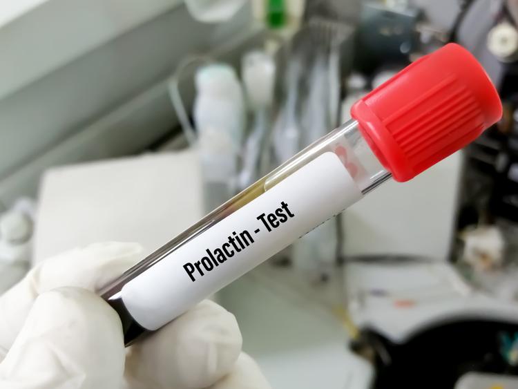 Prolactinomas: destaques do novo guideline