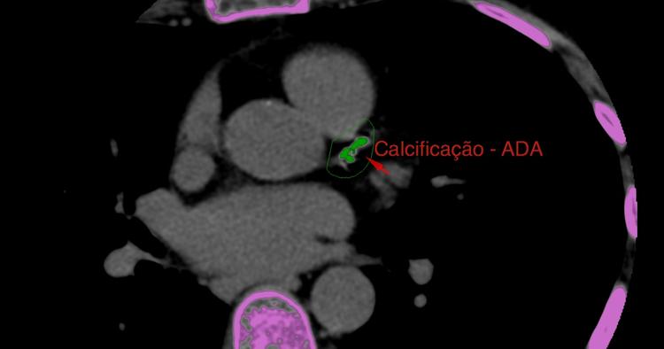 Escore cálcio de zero muda a sua conduta ou não?