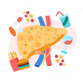 Novo guideline para o manejo da doença hepática gordurosa não alcoólica