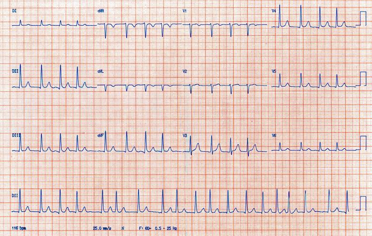 Câncer aumenta o risco de ocorrência de fibrilação atrial?