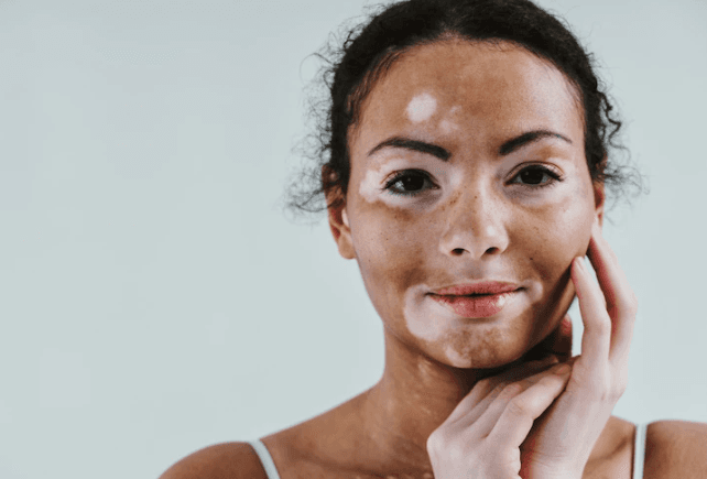 Por Que A Repigmentação Do Vitiligo Não É Homogênea?