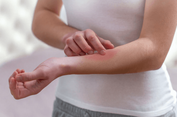 Leishmaniose Tegumentar Americana: Quando Optar Por Tratamento Intralesional?