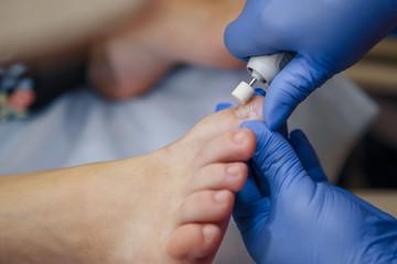 Você Já Atendeu Pacientes Que Sentem Dor Ao Apertar A Unha?