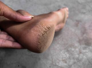 Ceratólise Plantar Sulcada: Você Conhece Essa Patologia?