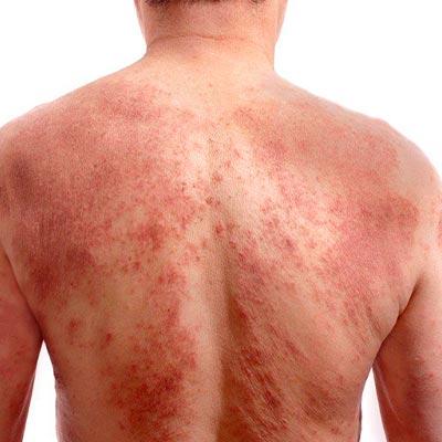 Paciente Com Lesões Urticadas: Quando Pensar Em Urticária Vasculite?