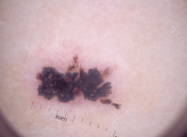 Nevo Melanocítico Recorrente