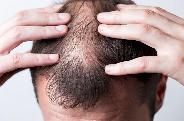 Você Conhece A Alopecia Por Pressão?