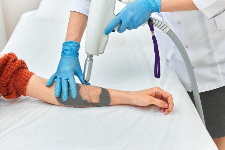 Você Sabe O Que É Fototermólise Seletiva?