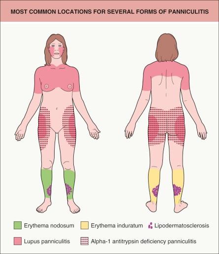 Paniculites: A Topografia Ajuda Na Suspeita Etiológica?